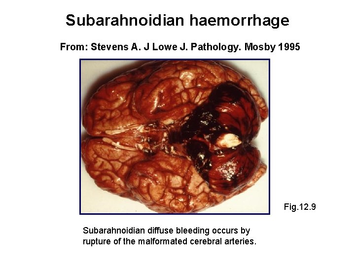 Subarahnoidian haemorrhage From: Stevens A. J Lowe J. Pathology. Mosby 1995 Fig. 12. 9