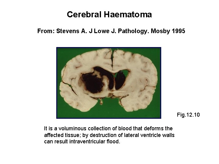 Cerebral Haematoma From: Stevens A. J Lowe J. Pathology. Mosby 1995 Fig. 12. 10
