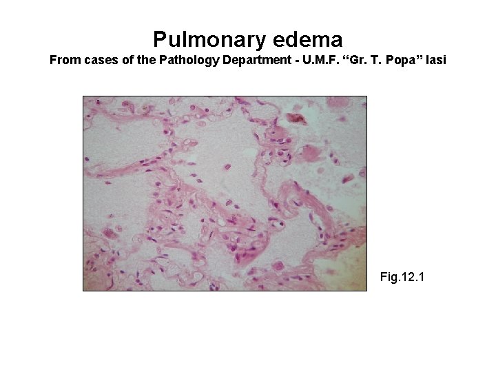 Pulmonary edema From cases of the Pathology Department - U. M. F. “Gr. T.