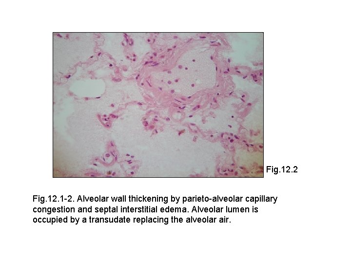 Fig. 12. 2 Fig. 12. 1 -2. Alveolar wall thickening by parieto-alveolar capillary congestion