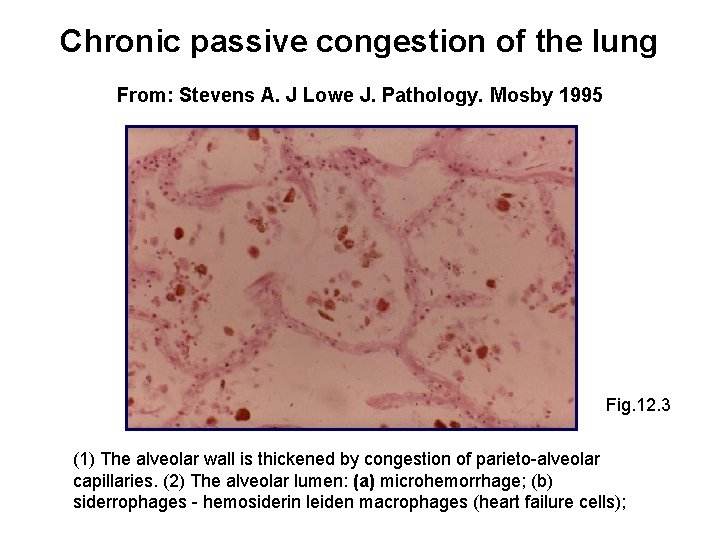 Chronic passive congestion of the lung From: Stevens A. J Lowe J. Pathology. Mosby