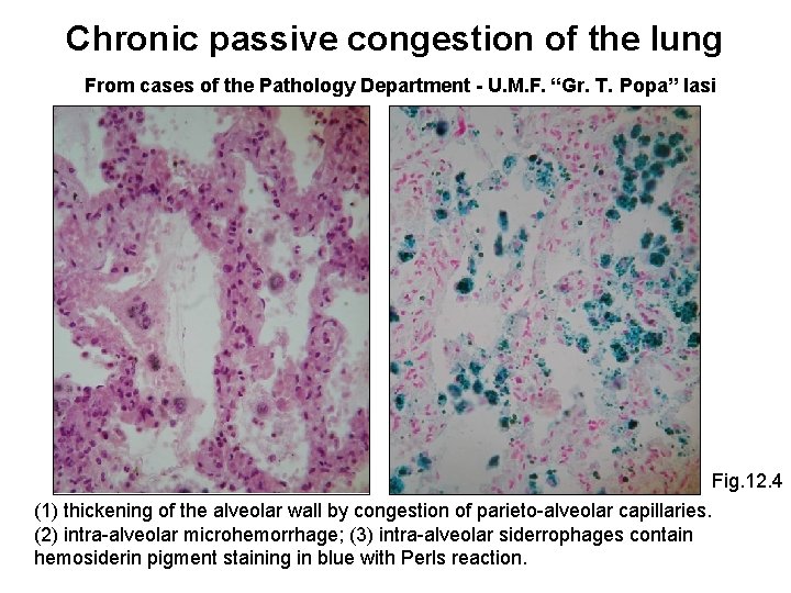 Chronic passive congestion of the lung From cases of the Pathology Department - U.
