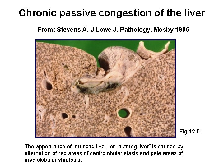 Chronic passive congestion of the liver From: Stevens A. J Lowe J. Pathology. Mosby