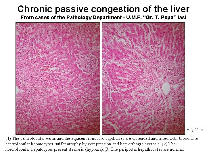 Chronic passive congestion of the liver From cases of the Pathology Department - U.