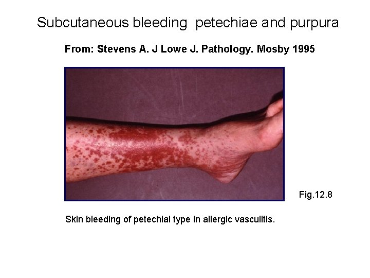 Subcutaneous bleeding petechiae and purpura From: Stevens A. J Lowe J. Pathology. Mosby 1995
