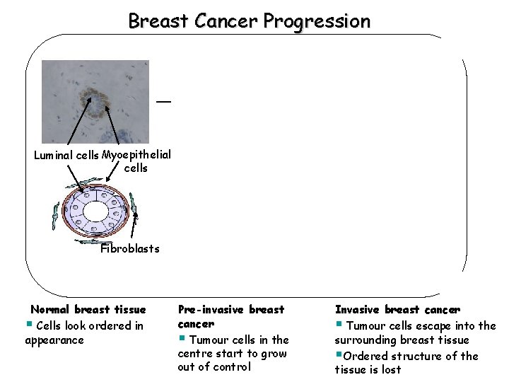 Breast Cancer Progression Luminal cells Myoepithelial cells Tumour cells Fibroblasts Normal breast tissue §