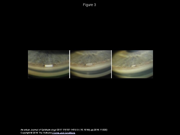 Figure 3 American Journal of Ophthalmology 2017 175137 -147 DOI: (10. 1016/j. ajo. 2016.