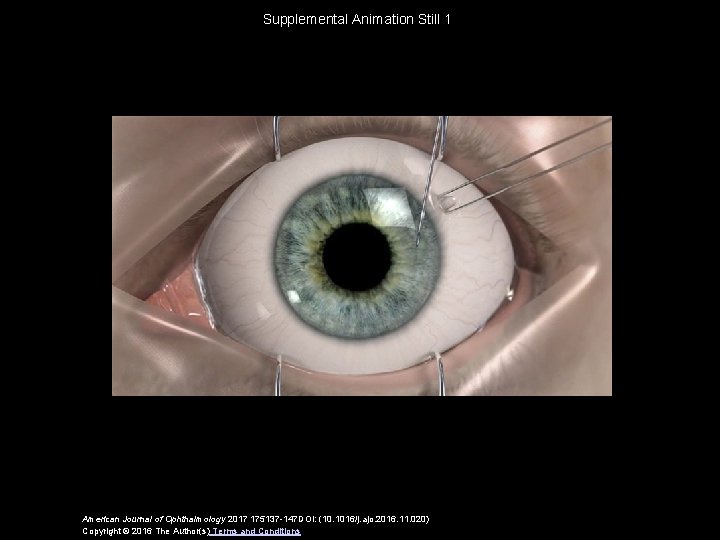 Supplemental Animation Still 1 American Journal of Ophthalmology 2017 175137 -147 DOI: (10. 1016/j.