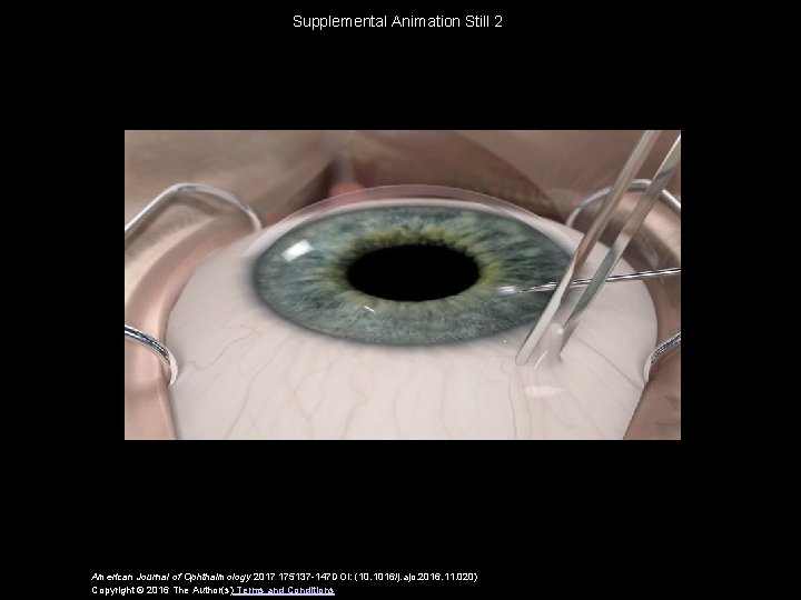 Supplemental Animation Still 2 American Journal of Ophthalmology 2017 175137 -147 DOI: (10. 1016/j.