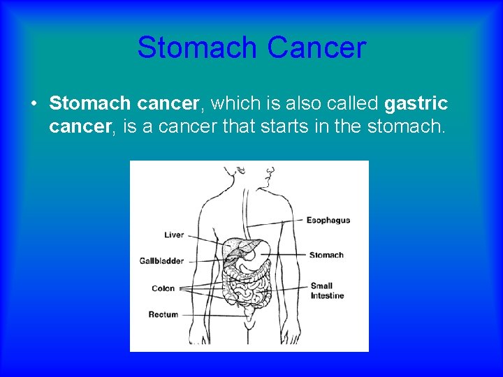 Stomach Cancer • Stomach cancer, which is also called gastric cancer, is a cancer