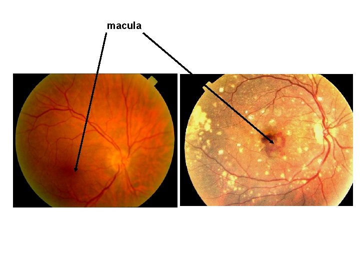 macula 