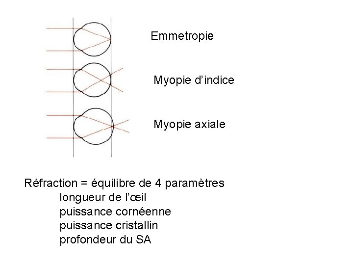 Emmetropie Myopie d’indice Myopie axiale Réfraction = équilibre de 4 paramètres longueur de l’œil
