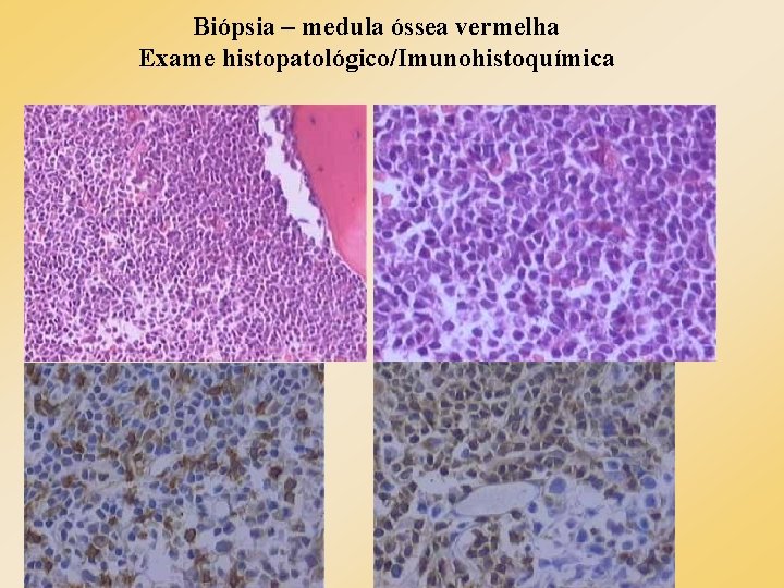 Biópsia – medula óssea vermelha Exame histopatológico/Imunohistoquímica 