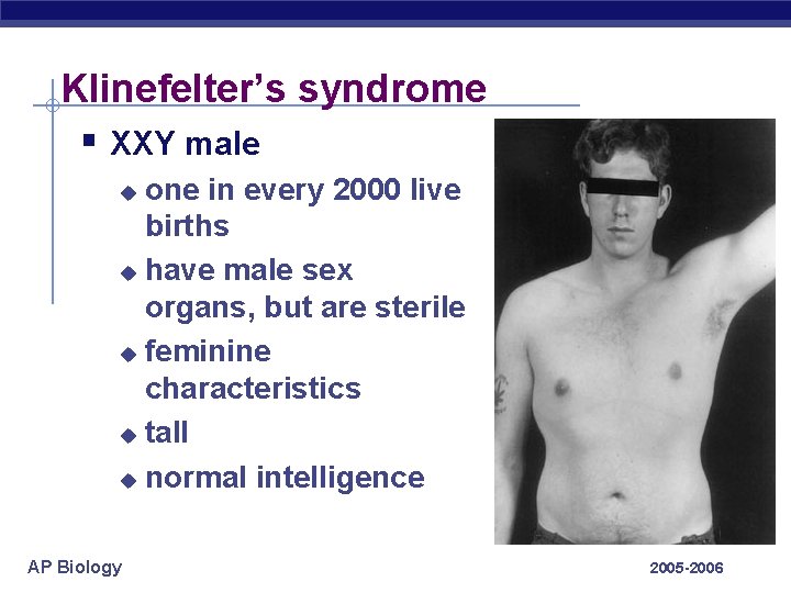 Klinefelter’s syndrome § XXY male one in every 2000 live births u have male