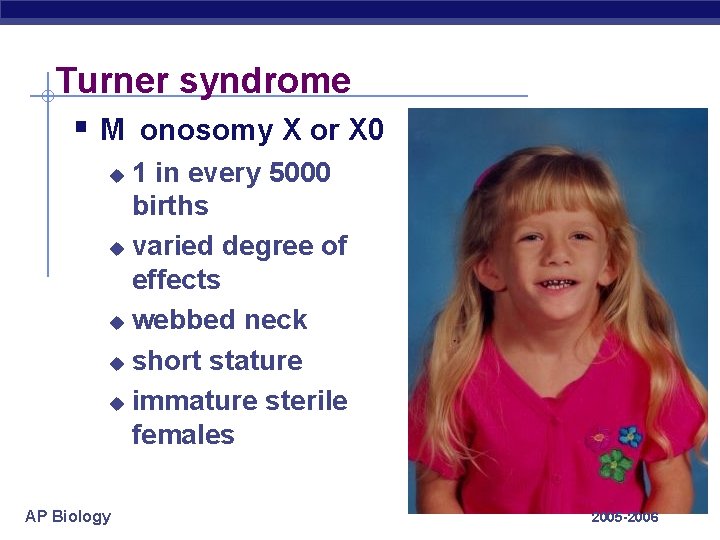 Turner syndrome § M onosomy X or X 0 1 in every 5000 births