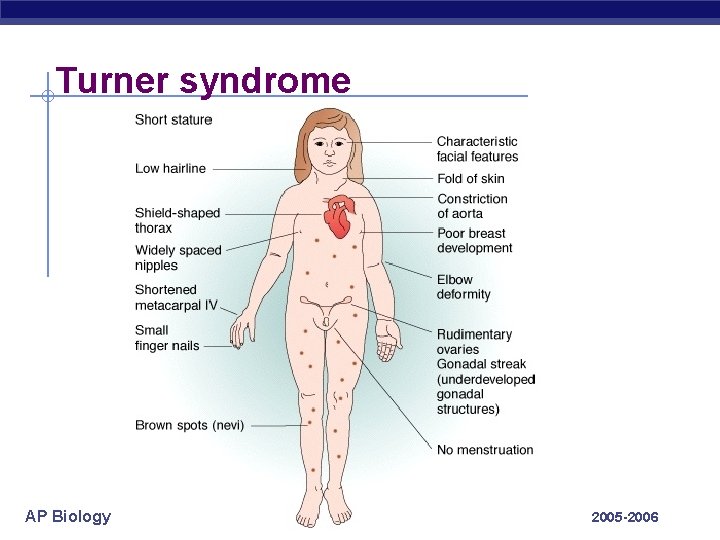Turner syndrome AP Biology 2005 -2006 