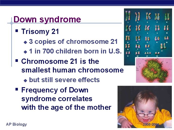 Down syndrome § Trisomy 21 3 copies of chromosome 21 u 1 in 700