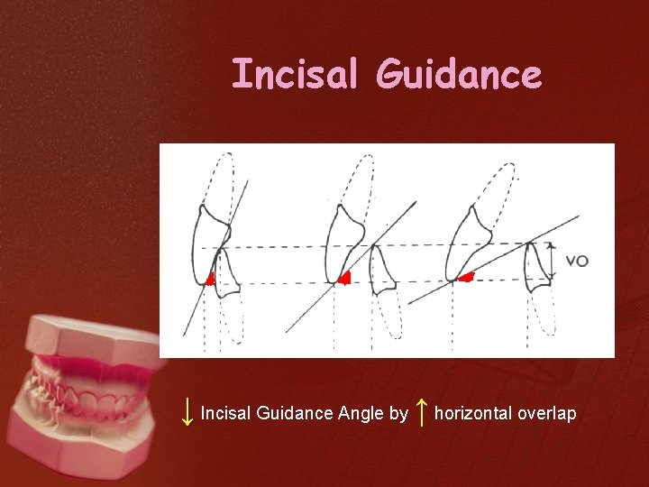 Incisal Guidance ↓ Incisal Guidance Angle by ↑ horizontal overlap 