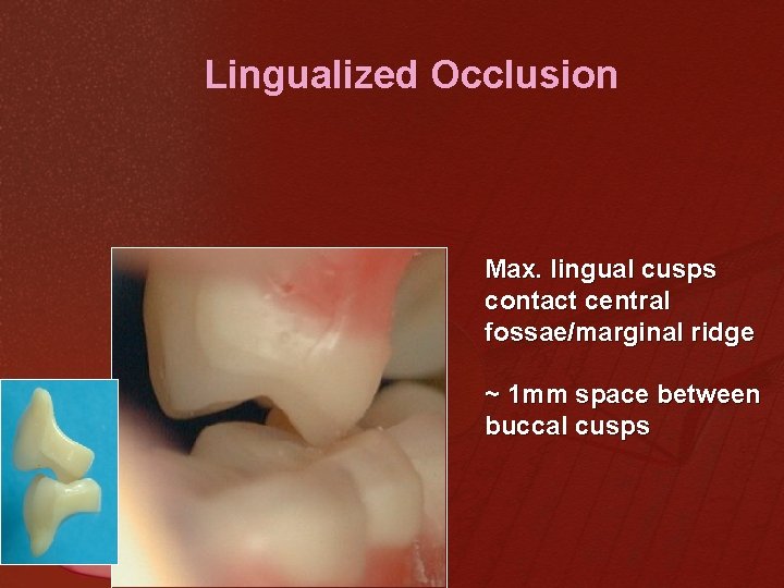 Lingualized Occlusion Max. lingual cusps contact central fossae/marginal ridge ~ 1 mm space between