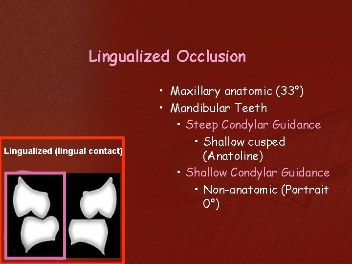 Lingualized Occlusion Lingualized (lingual contact) • Maxillary anatomic (33°) • Mandibular Teeth • Steep