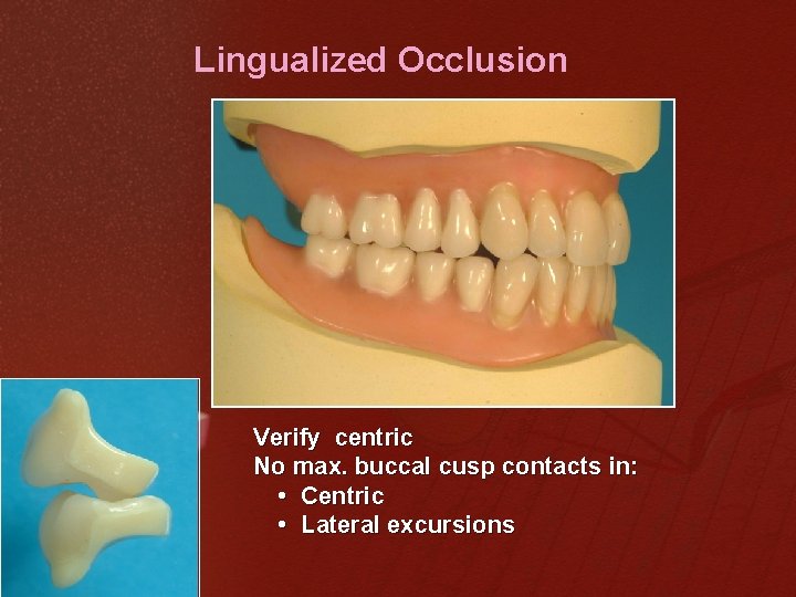 Lingualized Occlusion Verify centric No max. buccal cusp contacts in: • Centric • Lateral