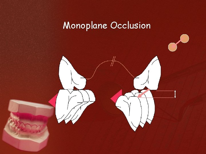 Monoplane Occlusion 