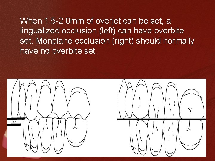 When 1. 5 -2. 0 mm of overjet can be set, a lingualized occlusion