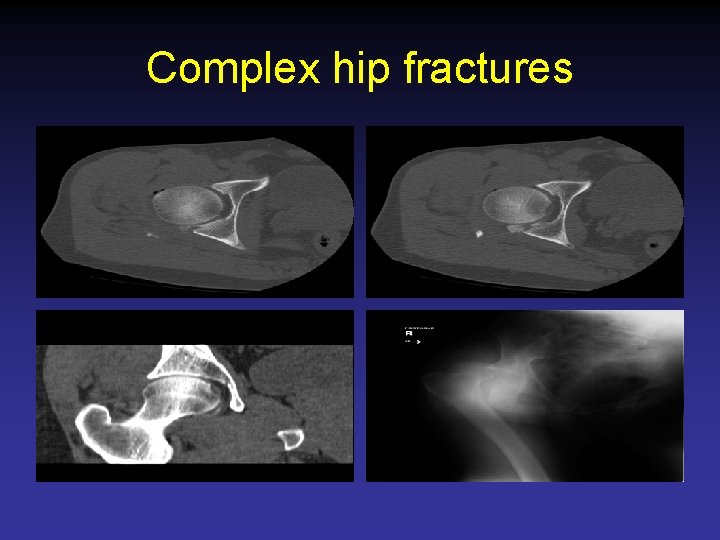 Complex hip fractures 