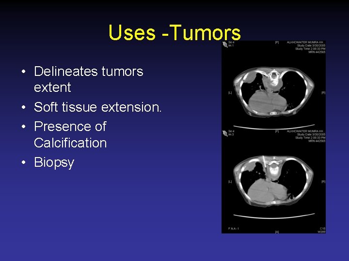 Uses -Tumors • Delineates tumors extent • Soft tissue extension. • Presence of Calcification