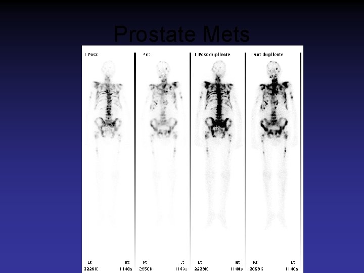 Prostate Mets 