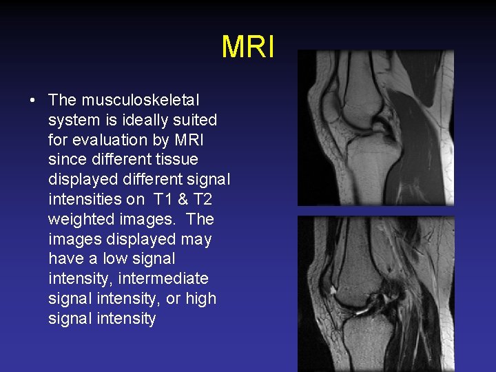 MRI • The musculoskeletal system is ideally suited for evaluation by MRI since different