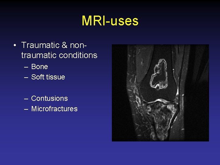 MRI-uses • Traumatic & nontraumatic conditions – Bone – Soft tissue – Contusions –