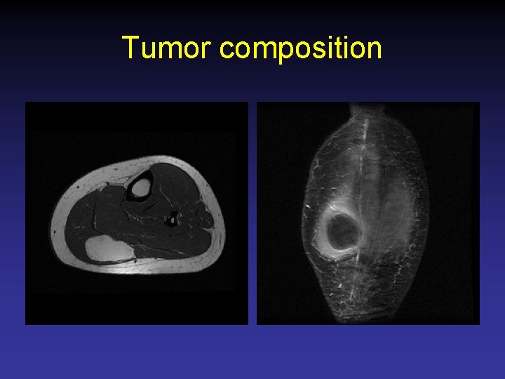 Tumor composition 