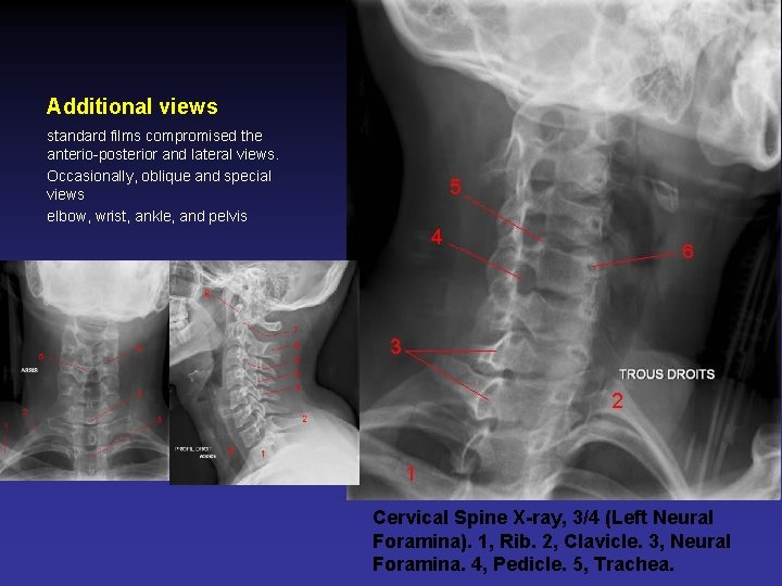 Additional views standard films compromised the anterio-posterior and lateral views. Occasionally, oblique and special