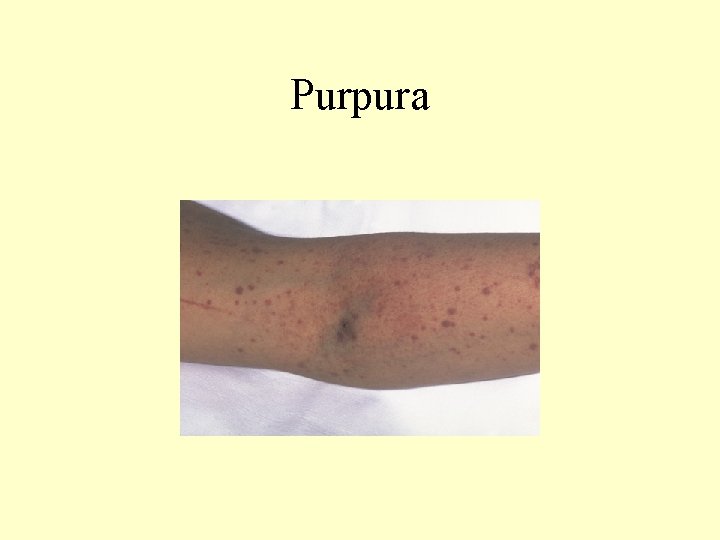 Purpura 