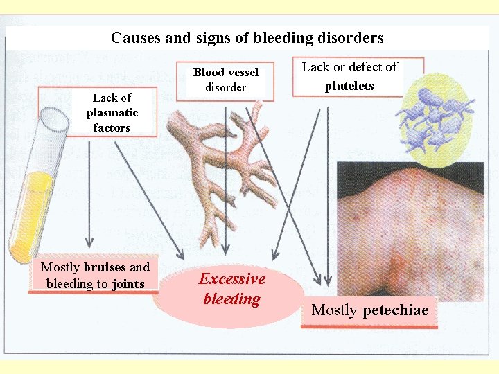 Causes and signs of bleeding disorders Lack of plasmatic factors Mostly bruises and bleeding
