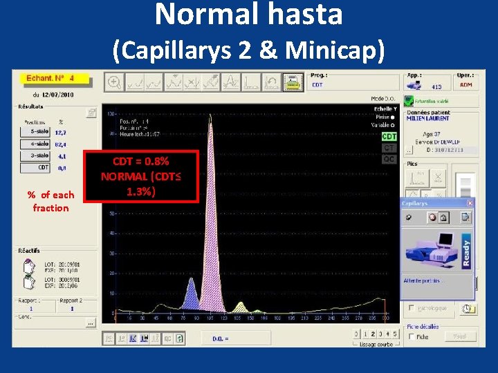 Normal hasta (Capillarys 2 & Minicap) % of each fraction CDT = 0. 8%