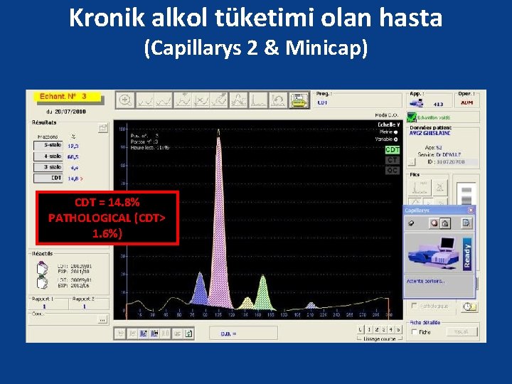 Kronik alkol tüketimi olan hasta (Capillarys 2 & Minicap) CDT = 14. 8% PATHOLOGICAL
