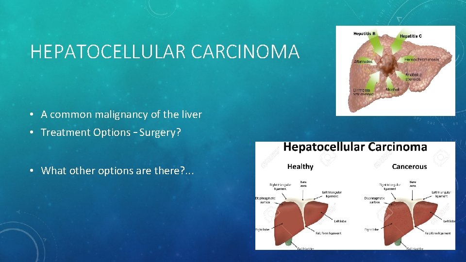 HEPATOCELLULAR CARCINOMA • A common malignancy of the liver • Treatment Options – Surgery?