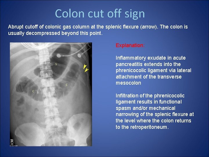 Colon cut off sign Abrupt cutoff of colonic gas column at the splenic flexure