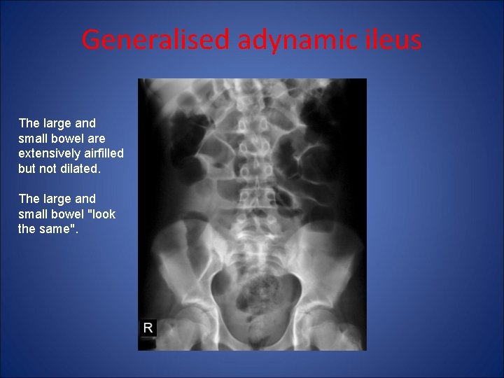 Generalised adynamic ileus The large and small bowel are extensively airfilled but not dilated.
