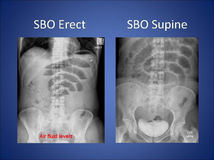 SBO Erect Air fluid levels SBO Supine 