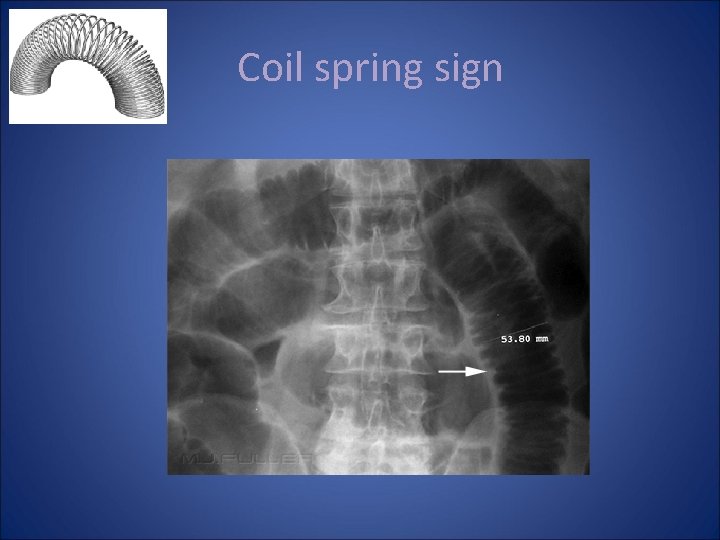 Coil spring sign 