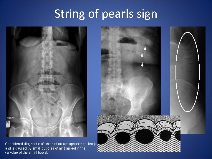 String of pearls sign Considered diagnostic of obstruction (as opposed to ileus) and is