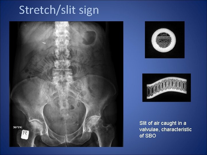 Stretch/slit sign Slit of air caught in a valvulae, characteristic of SBO 