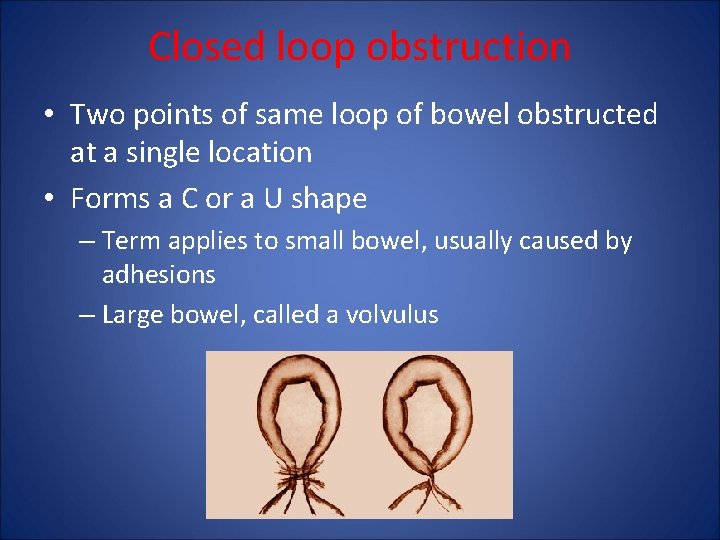 Closed loop obstruction • Two points of same loop of bowel obstructed at a