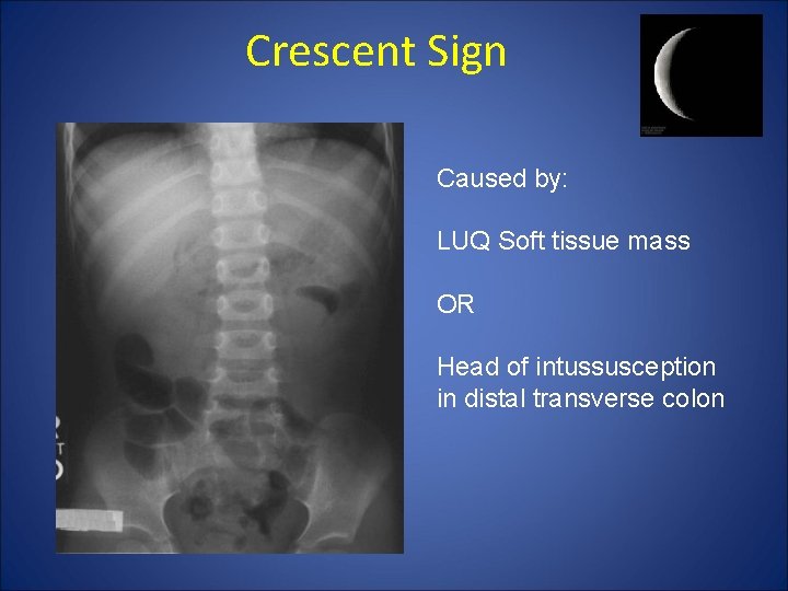 Crescent Sign Caused by: LUQ Soft tissue mass OR Head of intussusception in distal