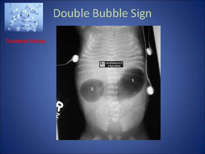 Double Bubble Sign Duodenal Atresia 