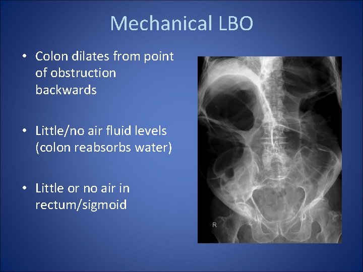 Mechanical LBO • Colon dilates from point of obstruction backwards • Little/no air fluid