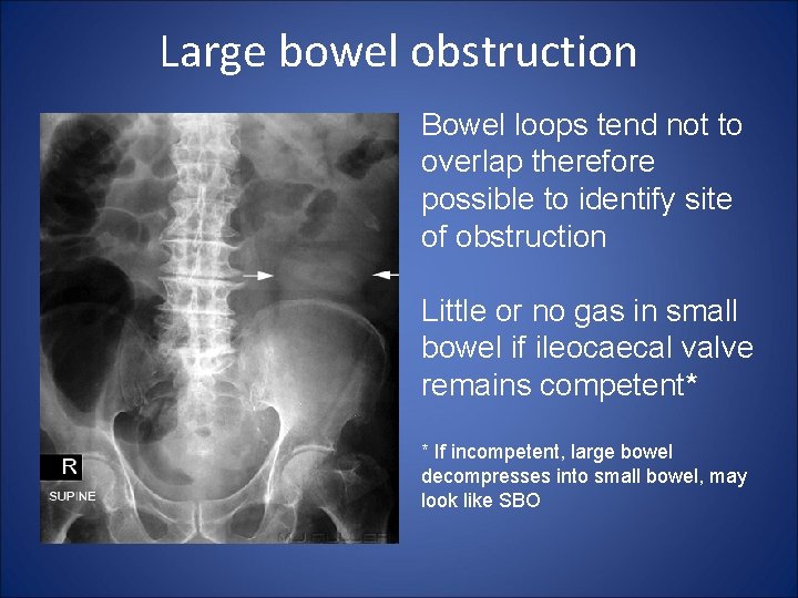 Large bowel obstruction Bowel loops tend not to overlap therefore possible to identify site